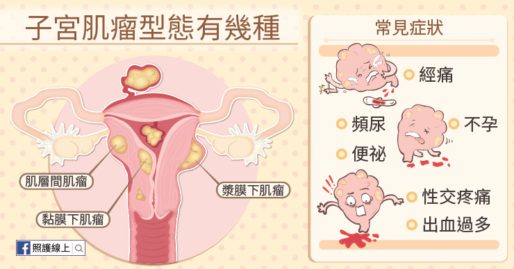 子宮肌瘤