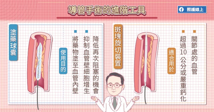 導管手術的進階工具