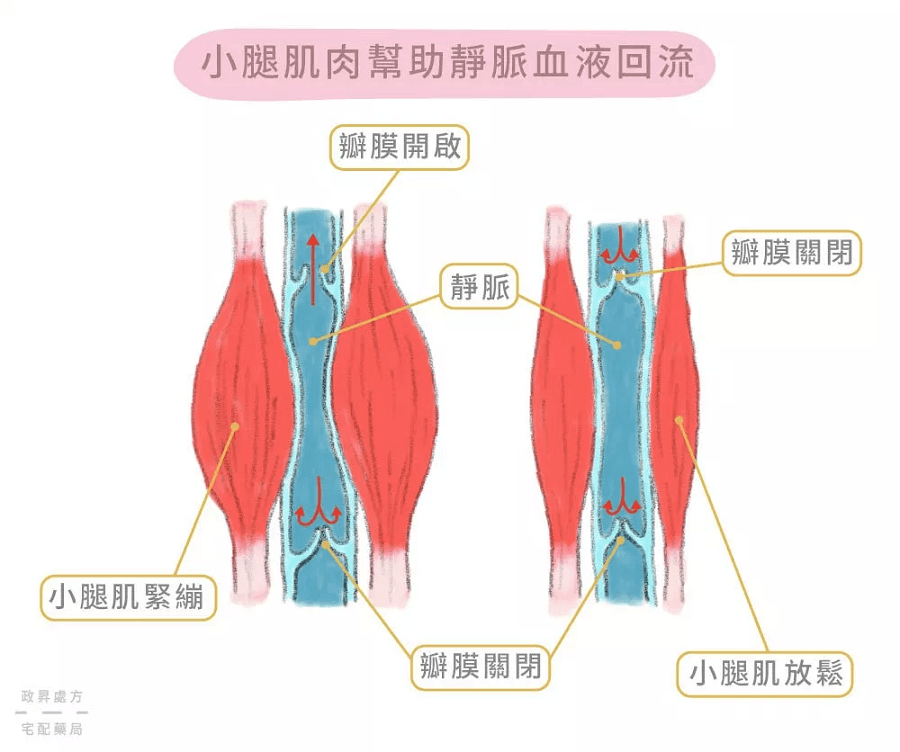 靜脈曲張