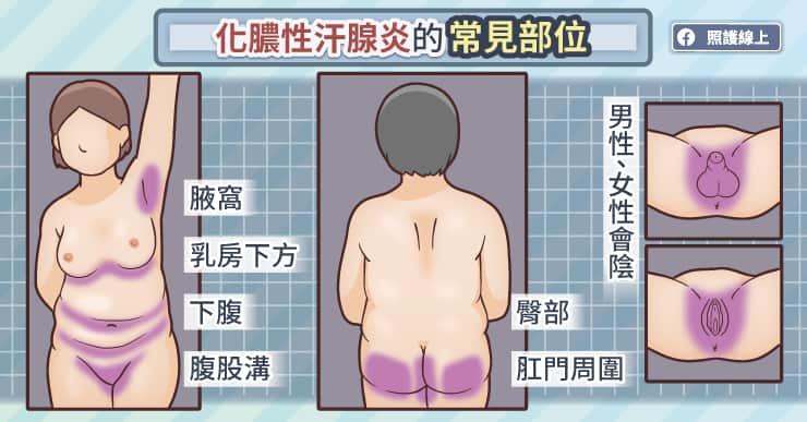 化膿性汗腺炎的常見部位
